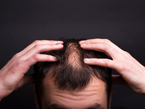 hair-loss-treatment-Sanjeeva Reddy Nagar-hyderabad