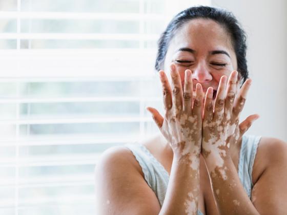 vitiligo-Sanjeeva Reddy Nagar-hyderabad